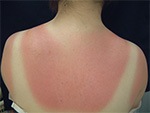 サンバーン(sunburn)
